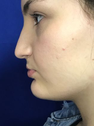 Injectables Minimally-Invasive / Fillers: Case 16 (23031) - Before