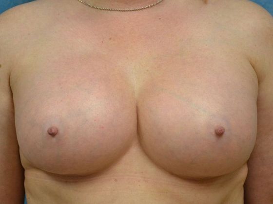 Breast Augmentation Case 1366- Maumee, OH - After