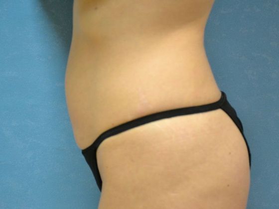 Tummy Tuck: Case 1677- Sylvania, OH - Before