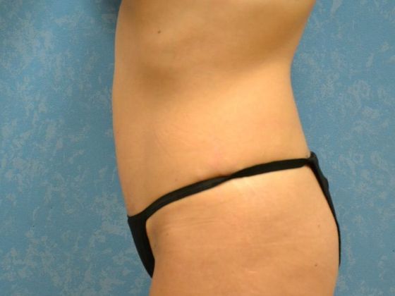 Tummy Tuck: Case 1677- Sylvania, OH - After