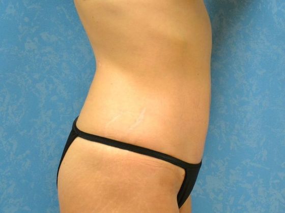 Tummy Tuck: Case 1677- Sylvania, OH - After