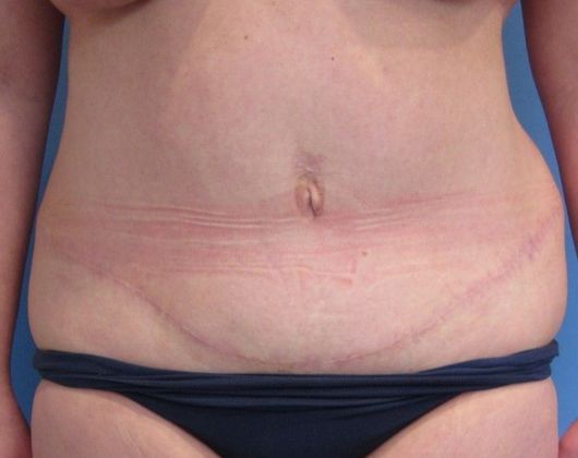 Tummy Tuck: Case 17 - Tummy Tuck, Trumbull, CT - After