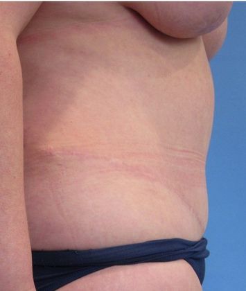 Tummy Tuck: Case 17 - Tummy Tuck, Trumbull, CT - After