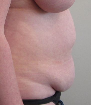 Tummy Tuck: Case 17 - Tummy Tuck, Trumbull, CT - Before