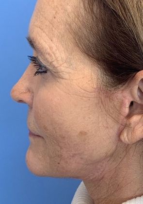 Facelift: Case 14 Facelift Westport - After