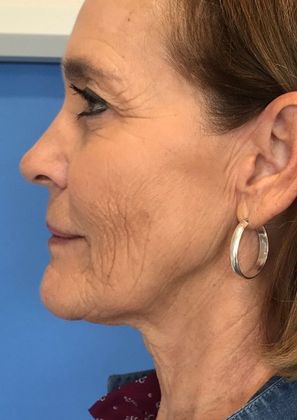 Facelift: Case 14 Facelift Westport - Before