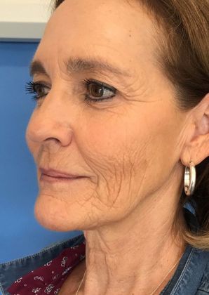 Facelift: Case 14 Facelift Westport - Before