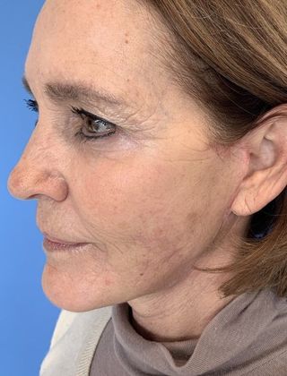 Facelift: Case 14 Facelift Westport - After