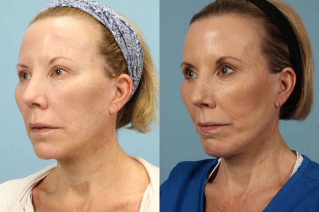 Before and after treatment, side view