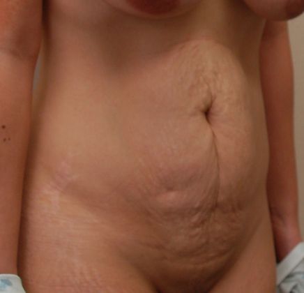 Tummy Tuck (Abdominoplasty): Case 197 - Before