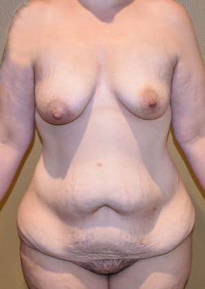 Massive Weight Loss  Case 58 - Before