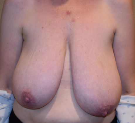 Breast Reduction Case 74 - Before