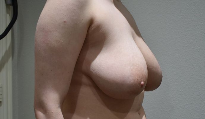 Breast Lift (Mastopexy): Case 72 - Before