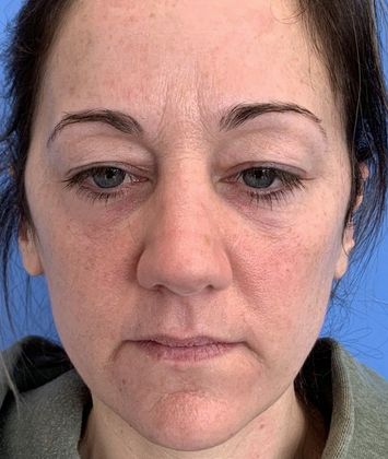 Eyelid Lift: Case 16 - Eyelid Lift, Norwalk CT - Before
