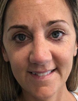 Eyelid Lift: Case 16 - Eyelid Lift, Norwalk CT - After