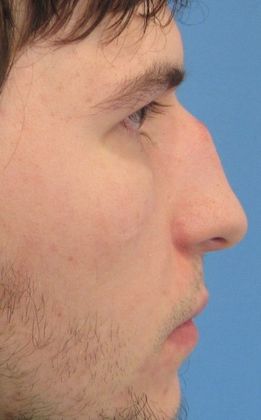 Rhinoplasty Case 16 Rhinoplasty, Cheshire - Before