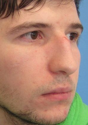 Rhinoplasty: Case 16 Rhinoplasty, Cheshire - Before