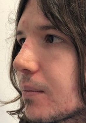 Rhinoplasty: Case 16 Rhinoplasty, Cheshire - After