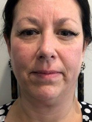 Eyelid Lift: Case 17 Upper Eyelid Lift, Rowayton - Before