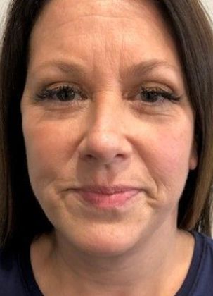 Eyelid Lift: Case 17 Upper Eyelid Lift, Rowayton - After