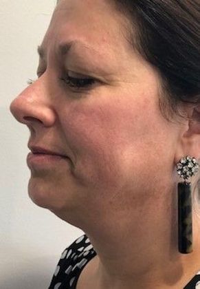 Eyelid Lift: Case 17 Upper Eyelid Lift, Rowayton - Before