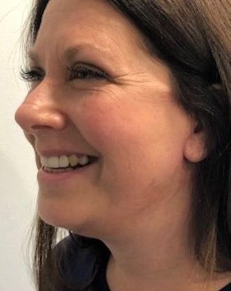 Eyelid Lift: Case 17 Upper Eyelid Lift, Rowayton - After