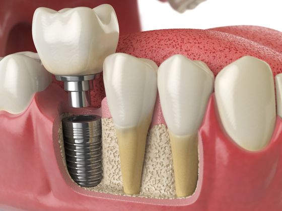 Dental Implants Case