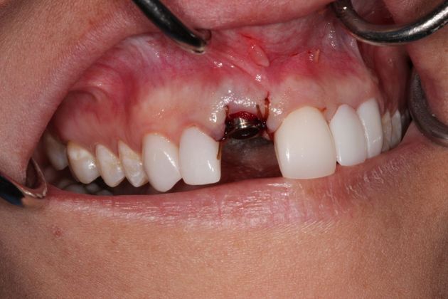 Dental Implants : Case 1 Same Day Dental Implant Replaces Missing Tooth - After