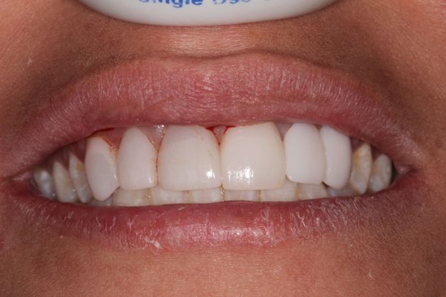 Dental Implants : Case 1 Same Day Dental Implant Replaces Missing Tooth - Before