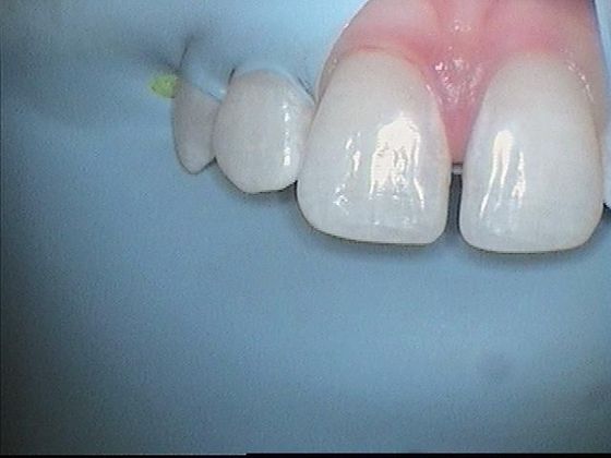Dental Bonding - Teeth Bonding  Case 1  Diastema "Split" Between Front Teeth Closed - Before
