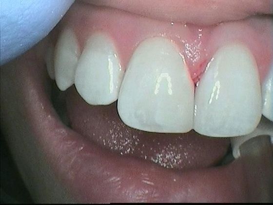 Dental Bonding - Teeth Bonding  Case 1  Diastema "Split" Between Front Teeth Closed - After
