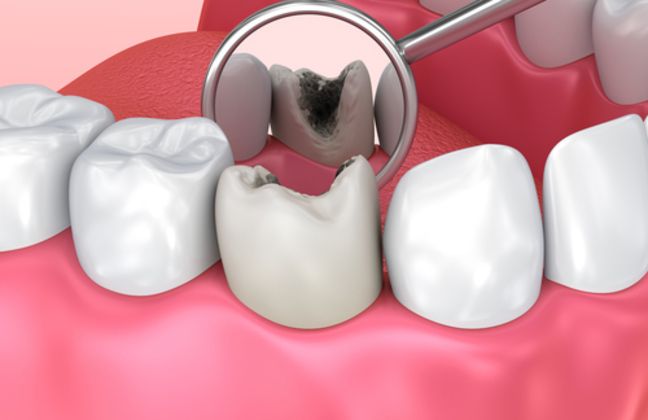 White Fillings Cases