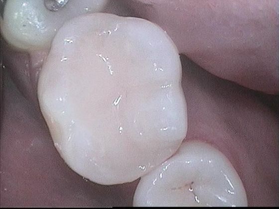 White Fillings Case 1- Tooth Filling Replacement  - After