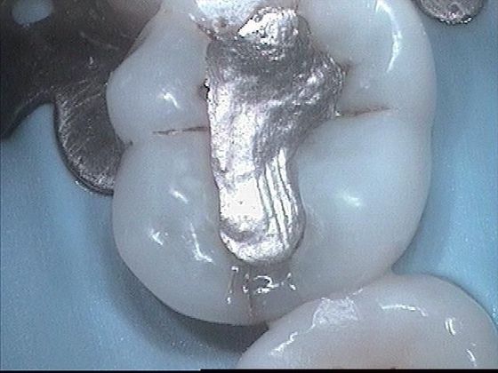 White Fillings Case 1- Tooth Filling Replacement  - Before