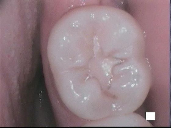 White Fillings Case 2  Composite Filling Replaces Dental Filling with Better Color Match - Before