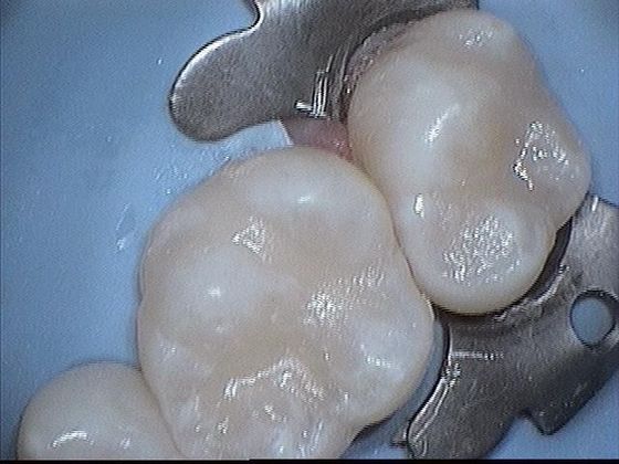 White Fillings Case 2  Composite Filling Replaces Dental Filling with Better Color Match - After