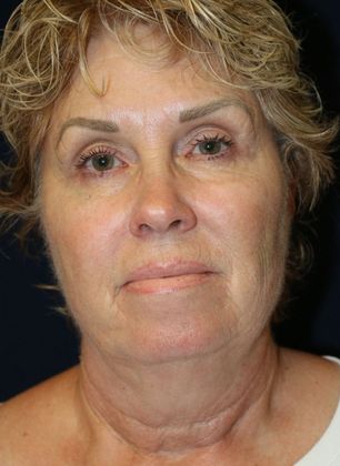 PDO Threads Case 7  - After