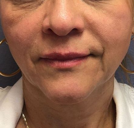 PDO Threads Case 6  - Before