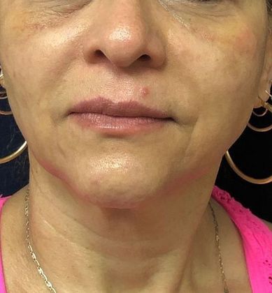 PDO Threads Case 6  - After