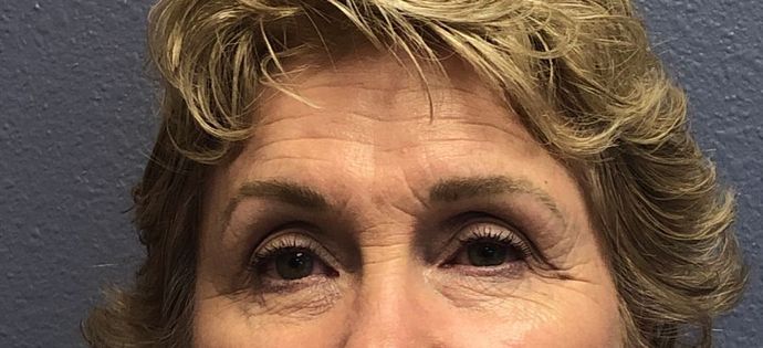 BOTOX® Cosmetic*: Case 1 - Before