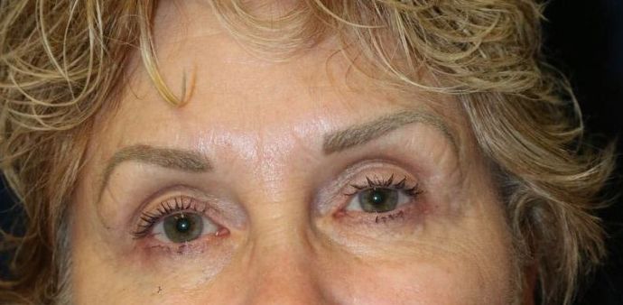 BOTOX® Cosmetic*: Case 1 - After