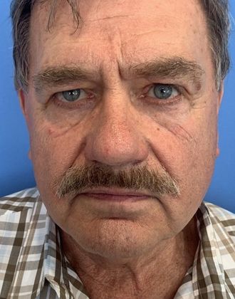 Facelift: Case 21 - Facelift, Norwalk, CT - Before