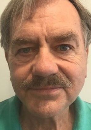 Facelift: Case 21 - Facelift, Norwalk, CT - After