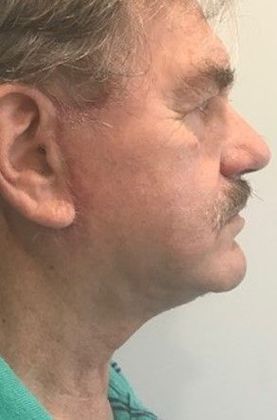 Facelift: Case 21 - Facelift, Norwalk, CT - After