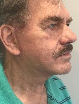 Facelift: Case 21 - Facelift, Norwalk, CT - After