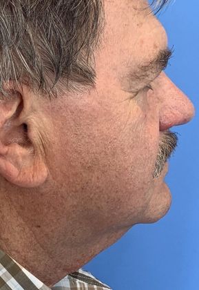 Facelift: Case 21 - Facelift, Norwalk, CT - Before