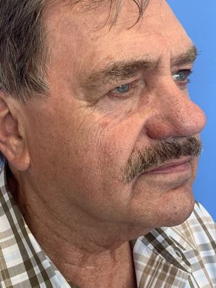 Facelift: Case 21 - Facelift, Norwalk, CT - Before