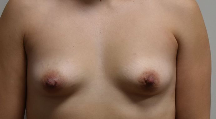 Breast Augmentation Case 562 - Before