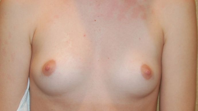 Breast Augmentation Case 563 - Before