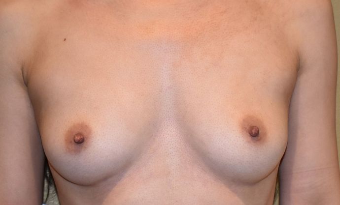 Breast Augmentation Case 564 - Before